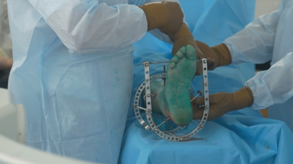 Bone Fracture. Medical Team in Hospital Operating Room Performing Operation alt