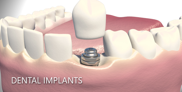 Dental Implants alt