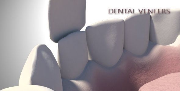 Dental Veneers alt