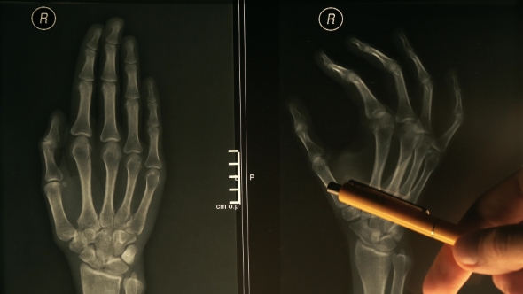 Doctor Explains Xray Image of a Hand alt