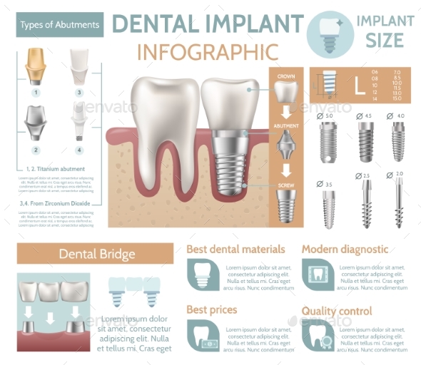 Dental Implant Tooth Care Medical Center Dentist - Health/Medicine Conceptual