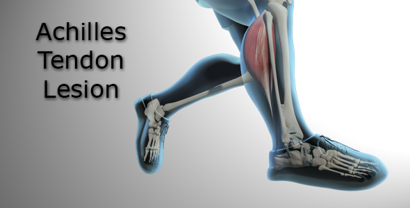 Achilles Tendon Lesion, Motion Graphics | VideoHive