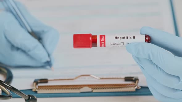 The Doctor Holds Hand Blood Sample Positive with Hepatitis B Virus alt