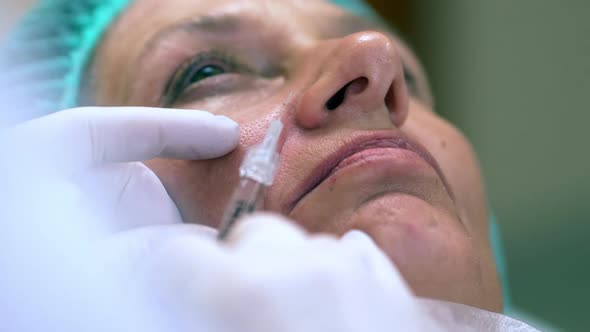 Closeup Shot of Middleaged Woman Getting Injections of Botox in Nasolabial Fold for Smoothing By alt