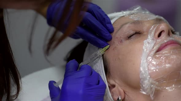 Hyaluronic acid injection for facial rejuvenation procedure. Close-up alt