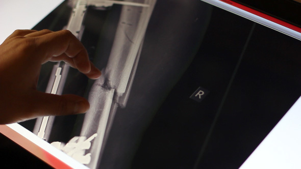 Doctor Analyzing X-Ray Of Broken Bone On Touch Screen Computer