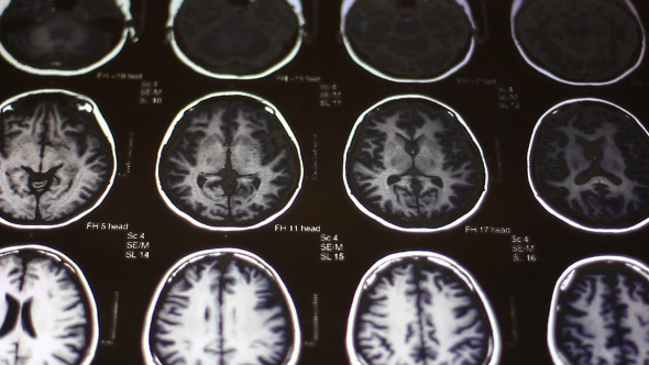 Doctor Examines Human Brain MRI Scan On Touch Screen Computer