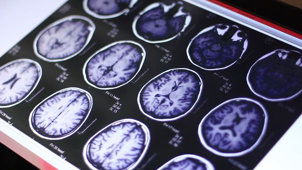 Doctor Examines Human Brain MRI Scan On Touch Screen Computer