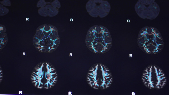 Doctor Examines Human Brain MRI Scan On Touch Screen Computer