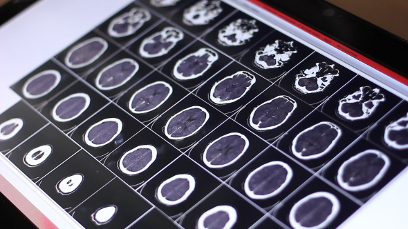 Doctor Examines Human Brain MRI Scan On Touch Screen Computer