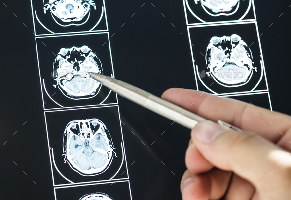 Closeup of brain MRI scan result - Stock Photo - Images