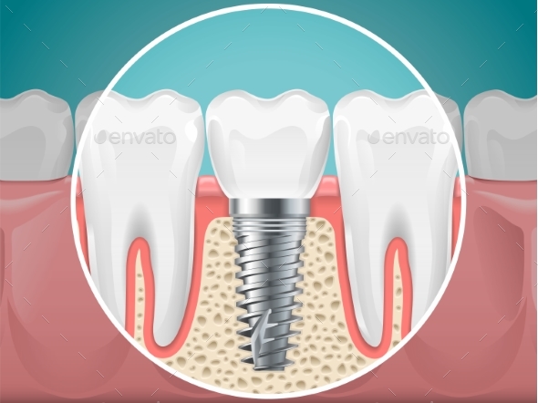 Stomatology Illustrations Dental Implants - Miscellaneous Vectors