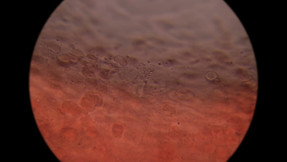 Border Collapsed, the Old Blood Similar To the Patient Under the Microscope alt