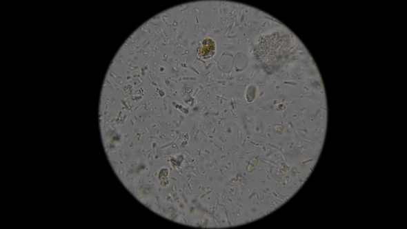 Tests of Liquid Feces in a Person Under a Microscope alt