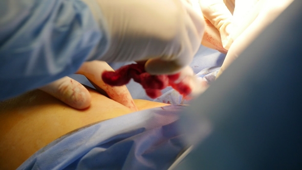 Surgery Operation and a Bloody Incision Sewn with a Thread By Hands in Gloves
