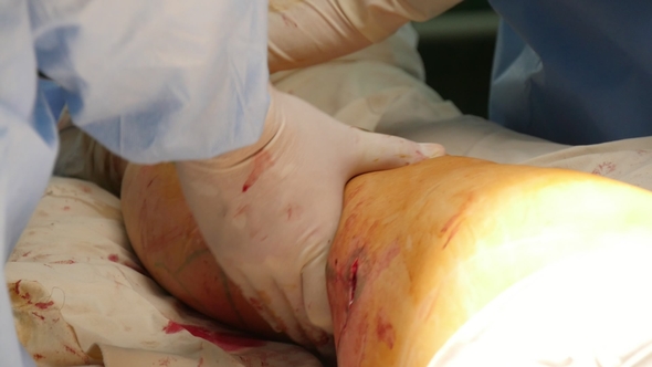 Leg with a Wound Is Operated By a Surgeon in White Gloves in a Hospital Room