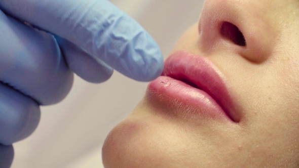 Face of Patient During Lip Augmentation