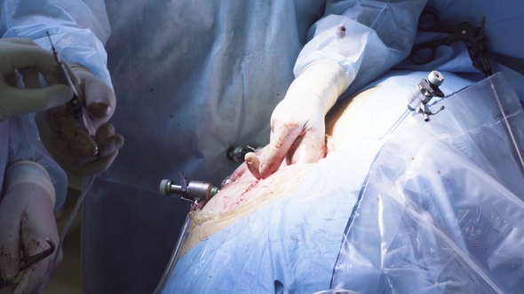 The Surgeon Making an Incision on the Abdomen