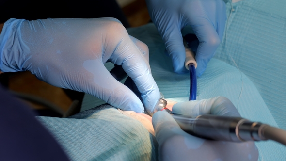 Led Photo-activator. Cosmetic Dentistry Veneers. Dental Spesialist Prepare Patient Teeth for Ceramic alt