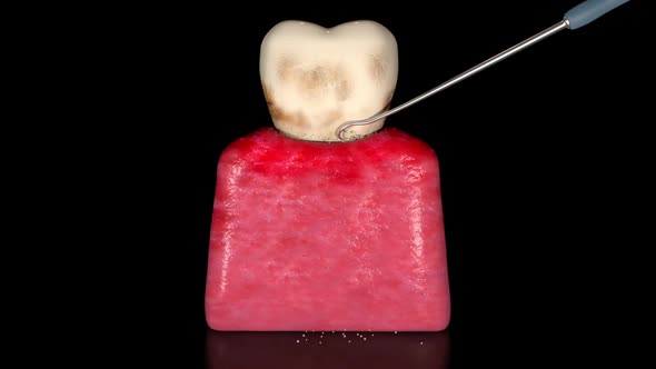 Dental Plaque And Tartar Removal alt