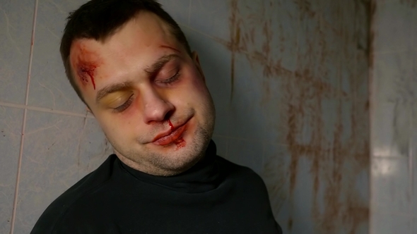 a Portrait of an Adult Male Who Has a Bruise on His Face, He Looks Like a Madman and Lies in a Dirty alt