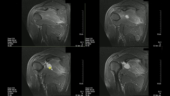 Real MRI Scan of Doctor Examining Male Shoulder and Finding a Lesion an Oedema alt