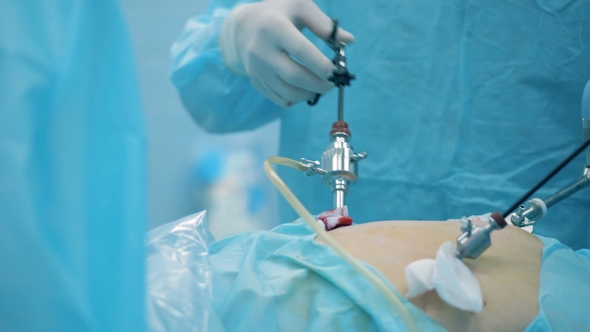 Doctors Are Carrying Out an Endoscopic Operation, Stock Footage | VideoHive