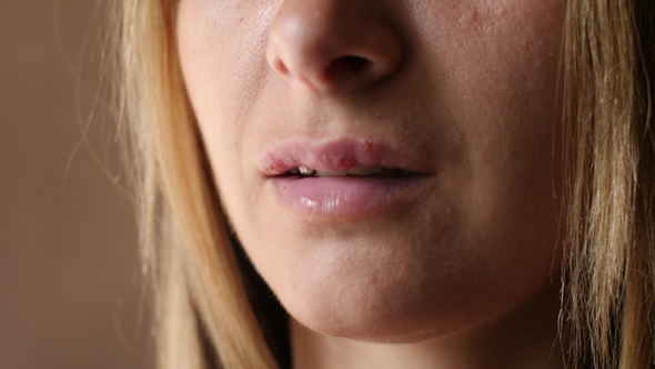 Beautiful Young Woman with Sores From Herpes on Her Lips. The Girl Is Sick of Laughing Because of