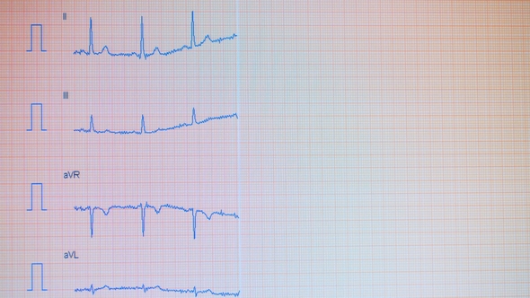 Screen with Electrocardiographic Curvatures Getting Drawn on It. Heart Pulse Line alt