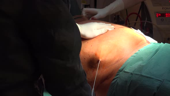 Liposuction And  Belly Fat 3