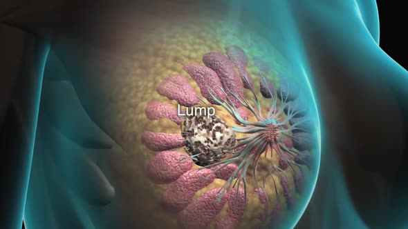 Breast Cancer, Ductal Carcinoma alt