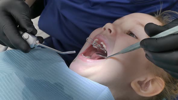Closeup of the Hands of a Pediatric Dentist in Black Gloves Dry a Drilled Hole in the Tooth of the alt