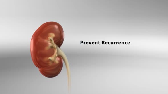 kidney stone formed in the human kidney alt