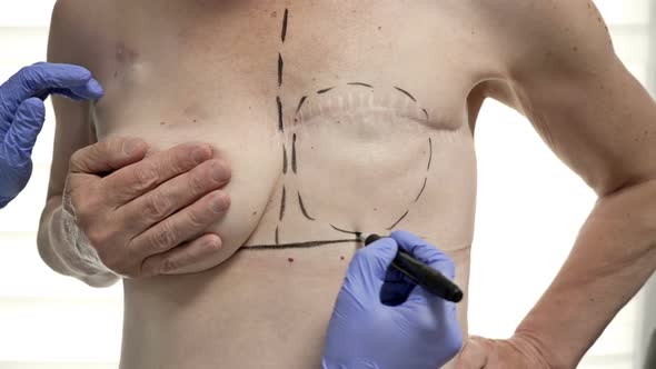 Preparing for Breast Reconstruction for a Woman Undergoing Mastectomy alt