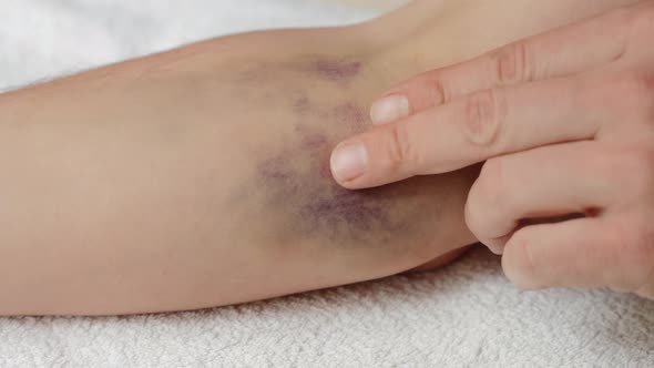 Man Touches Hematoma on the Elbow