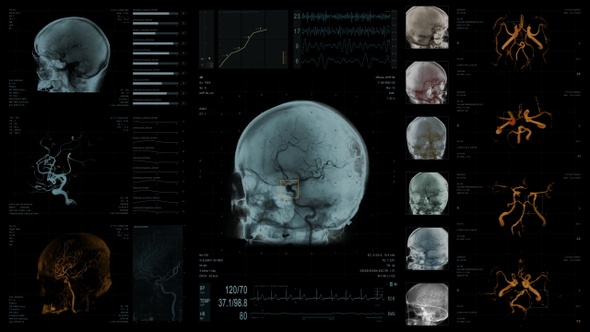 Medical Screen. Cerebral Angiographia. 4K