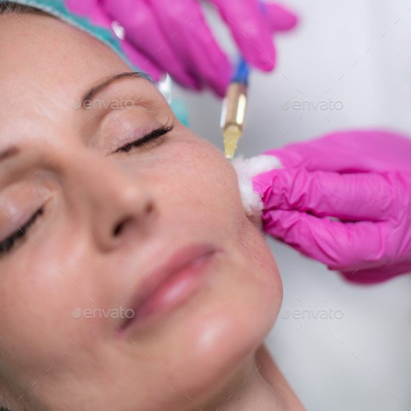 Hyaluronic Acid Injection Fillers for Cheeks Stock Photo by microgen