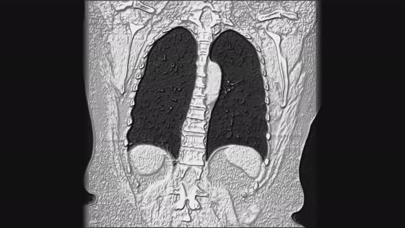 Voluminous MRI of the Lungs and Bronchi, Diagnosis of Viral or Covid-19 Respiratory Disease alt