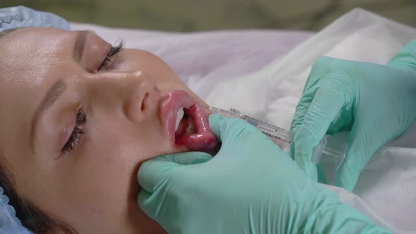 Beautician Does the Procedure of Lip Augmentation with a Hyaluron Injection alt