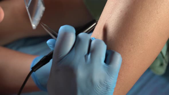 Electrologist Remove Hair in a Woman's Leg Using Metod Electro Epilation in Black Gloves alt