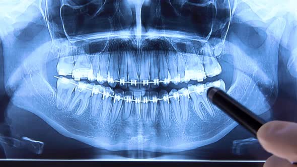 Stomatologist Analyzing Dental Radiography with Braces