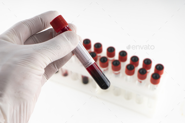 Test tube containing a blood sample test tube for Covid-19 (coronavirus) analyzing - Stock Photo - Images