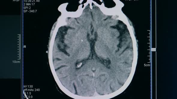 Brain Scanning Picture Is Fading Away on a Monitor alt