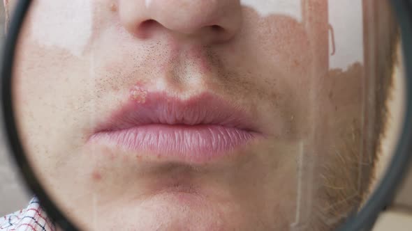 Herpes On The Lip Of A Man Through A Magnifying Glass, A Pimple On The Lip. Viral Herpes In Humans