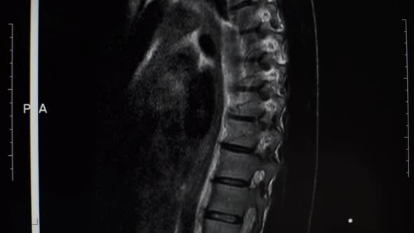 Magnetic Resonance Imaging of the Spine of a Man