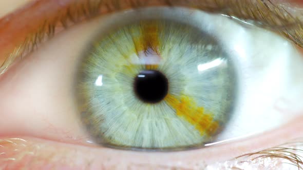 Male Opening Eye To Reveal Pupil With Brown Birthmark In Iris 