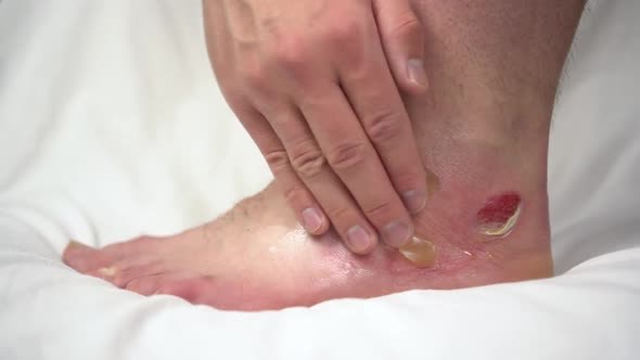 A Man Smears an Ointment on a Leg with a Second-degree Hot Water Burn. The Skin Was Swollen in Lumps alt