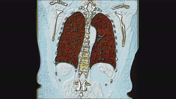 Color MRI of the Lungs and Bronchi, Diagnosis of Viral or Covid-19 Respiratory Disease alt