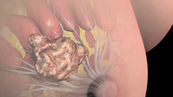 Breast cancer is cancer that forms in the cells of the breasts. alt