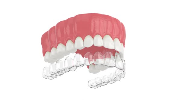 Invisalign removable and invisible retainer placement on upper jaw over white background